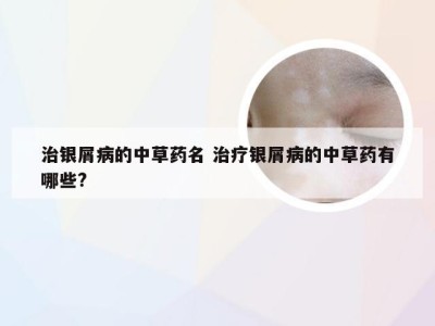 治银屑病的中草药名 治疗银屑病的中草药有哪些?