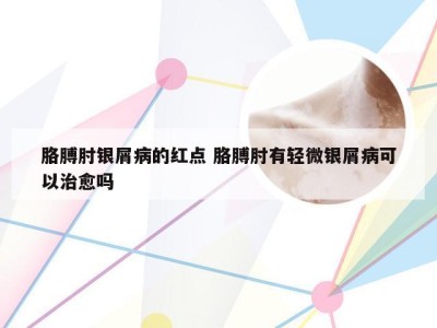 胳膊肘银屑病的红点 胳膊肘有轻微银屑病可以治愈吗