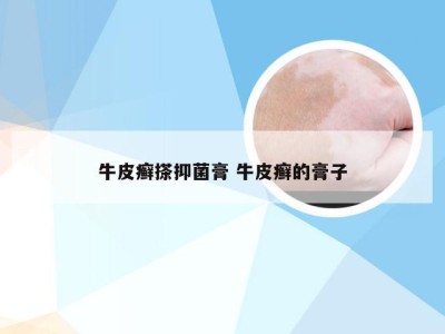 牛皮癣搽抑菌膏 牛皮癣的膏子