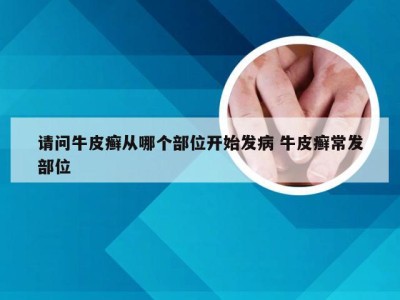 请问牛皮癣从哪个部位开始发病 牛皮癣常发部位