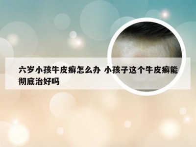 六岁小孩牛皮癣怎么办 小孩子这个牛皮癣能彻底治好吗