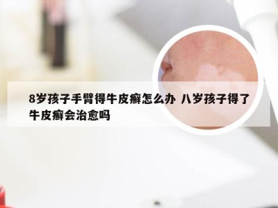 8岁孩子手臂得牛皮癣怎么办 八岁孩子得了牛皮癣会治愈吗