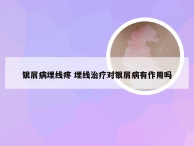 银屑病埋线疼 埋线治疗对银屑病有作用吗