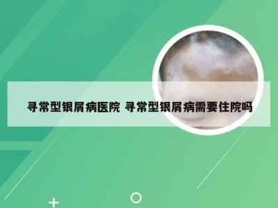 寻常型银屑病医院 寻常型银屑病需要住院吗