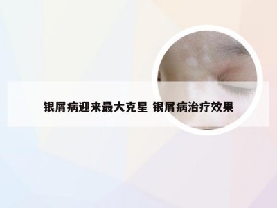 银屑病迎来最大克星 银屑病治疗效果