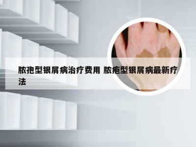 脓孢型银屑病治疗费用 脓疱型银屑病最新疗法