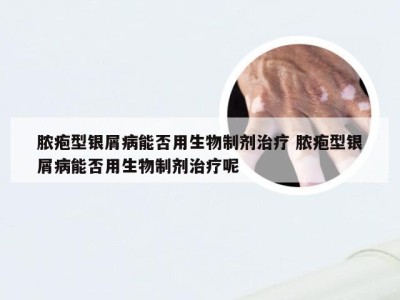 脓疱型银屑病能否用生物制剂治疗 脓疱型银屑病能否用生物制剂治疗呢