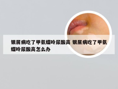 银屑病吃了甲氨蝶呤尿酸高 银屑病吃了甲氨蝶呤尿酸高怎么办