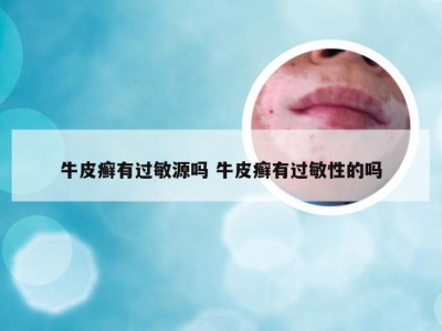 牛皮癣有过敏源吗 牛皮癣有过敏性的吗
