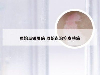 原始点银屑病 原始点治疗皮肤病