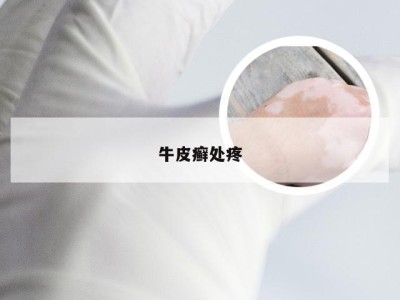 牛皮癣处疼