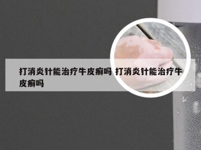 打消炎针能治疗牛皮癣吗 打消炎针能治疗牛皮癣吗