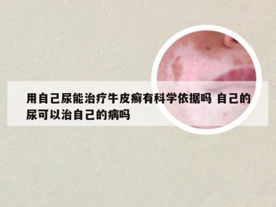 用自己尿能治疗牛皮癣有科学依据吗 自己的尿可以治自己的病吗