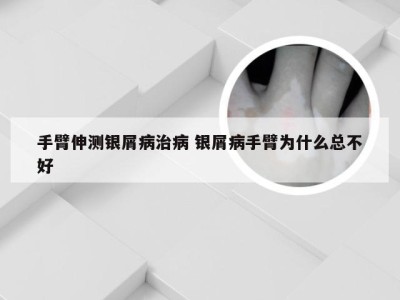 手臂伸测银屑病治病 银屑病手臂为什么总不好