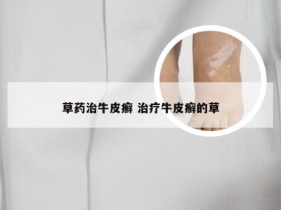 草药治牛皮癣 治疗牛皮癣的草