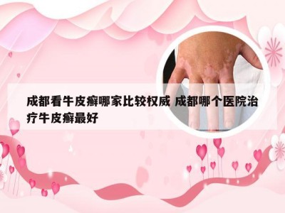 成都看牛皮癣哪家比较权威 成都哪个医院治疗牛皮癣最好