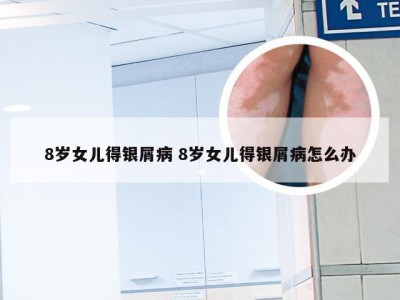 8岁女儿得银屑病 8岁女儿得银屑病怎么办
