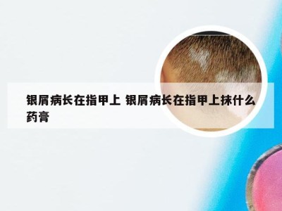 银屑病长在指甲上 银屑病长在指甲上抹什么药膏