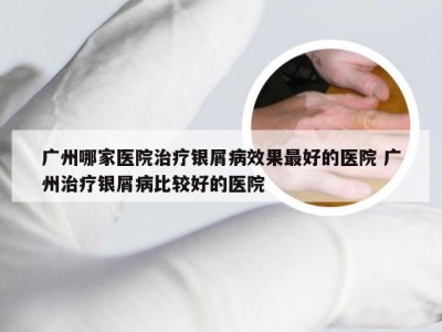 广州哪家医院治疗银屑病效果最好的医院 广州治疗银屑病比较好的医院