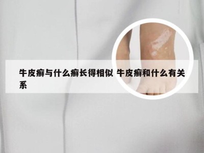 牛皮癣与什么癣长得相似 牛皮癣和什么有关系