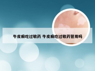 牛皮癣吃过敏药 牛皮癣吃过敏药管用吗