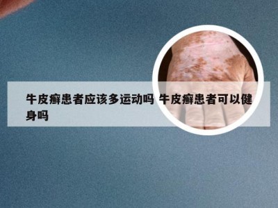 牛皮癣患者应该多运动吗 牛皮癣患者可以健身吗