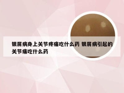 银屑病身上关节疼痛吃什么药 银屑病引起的关节痛吃什么药