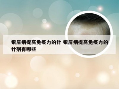 银屑病提高免疫力的针 银屑病提高免疫力的针剂有哪些