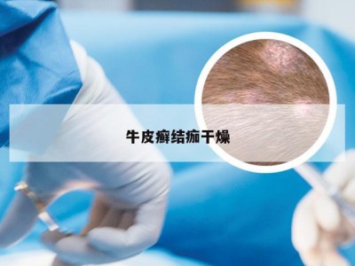 牛皮癣结痂干燥