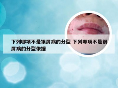 下列哪项不是银屑病的分型 下列哪项不是银屑病的分型依据