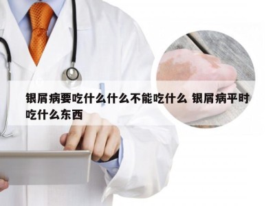 银屑病要吃什么什么不能吃什么 银屑病平时吃什么东西