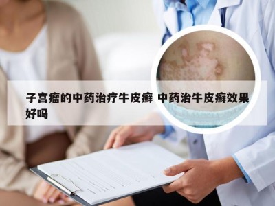 子宫瘤的中药治疗牛皮癣 中药治牛皮癣效果好吗