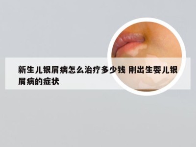 新生儿银屑病怎么治疗多少钱 刚出生婴儿银屑病的症状