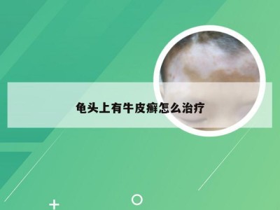 龟头上有牛皮癣怎么治疗
