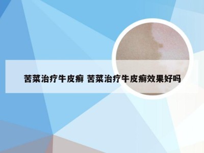 苦菜治疗牛皮癣 苦菜治疗牛皮癣效果好吗