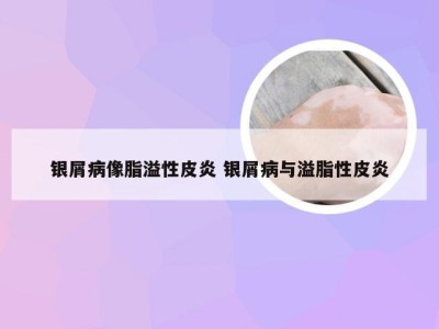 银屑病像脂溢性皮炎 银屑病与溢脂性皮炎