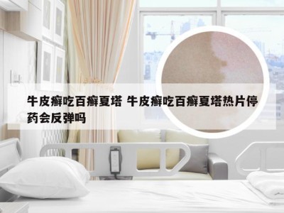 牛皮癣吃百癣夏塔 牛皮癣吃百癣夏塔热片停药会反弹吗