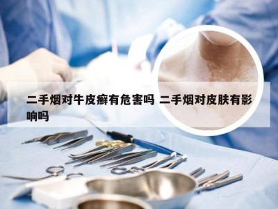 二手烟对牛皮癣有危害吗 二手烟对皮肤有影响吗