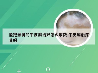 能把顽固的牛皮癣治好怎么收费 牛皮癣治疗贵吗