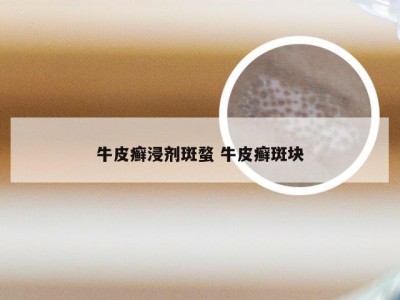 牛皮癣浸剂斑蝥 牛皮癣斑块