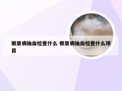 银屑病抽血检查什么 银屑病抽血检查什么项目