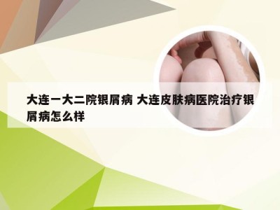 大连一大二院银屑病 大连皮肤病医院治疗银屑病怎么样