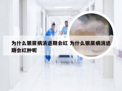为什么银屑病消退期会红 为什么银屑病消退期会红肿呢