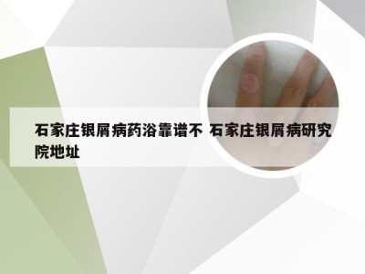 石家庄银屑病药浴靠谱不 石家庄银屑病研究院地址