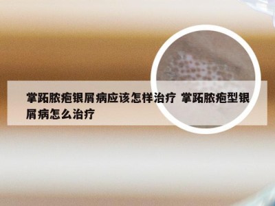 掌跖脓疱银屑病应该怎样治疗 掌跖脓疱型银屑病怎么治疗