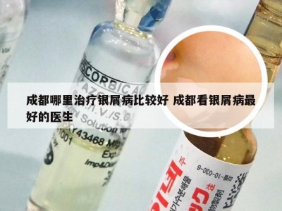 成都哪里治疗银屑病比较好 成都看银屑病最好的医生