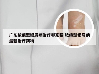 广东脓疱型银屑病治疗哪家强 脓疱型银屑病最新治疗药物