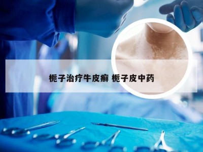 栀子治疗牛皮癣 栀子皮中药