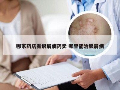 哪家药店有银屑病药卖 哪里能治银屑病