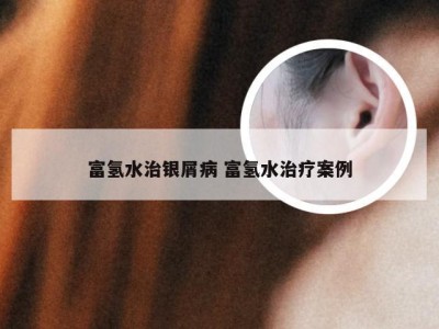 富氢水治银屑病 富氢水治疗案例